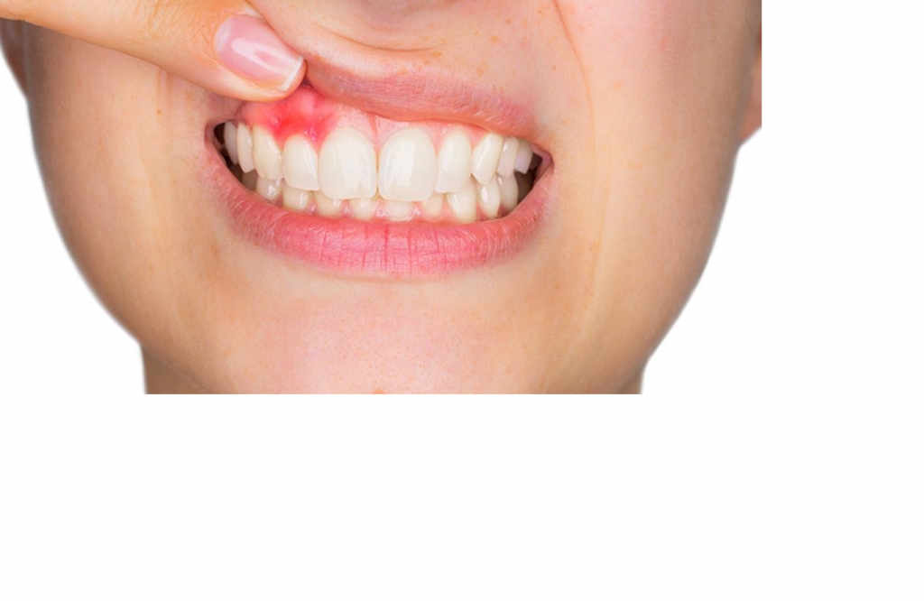 Неподвижна протетика: Инлеи, Онлеи и Керамични фасети